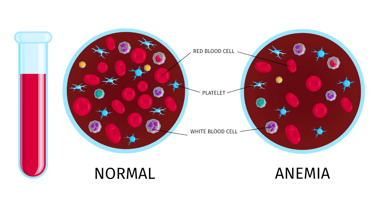 Anemia